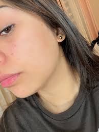 Acne scar treatment and pore shrinking tips