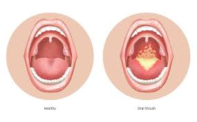 Image result for oral thrush symptoms roof of the mouth