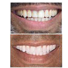 Pin On Before And After