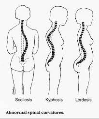 Abnormal Curvature Of The Back Problems Anatomy Bones Human Spine Medical Anatomy