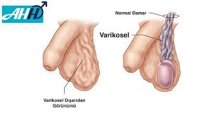 Varikosel Ameliyati Ankara Prof Dr Ahmet Hakan Haliloglu