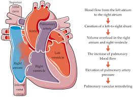 Image result for Atrial Septal Defect