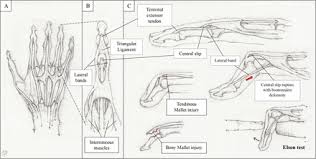 Image result for Elson Extensor Tendon Test