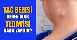lipom yag bezesi nasil gecer tedavisi nasil yapilir