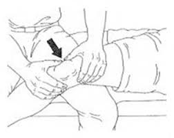 Image result for Patellar Apprehension Test