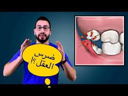 ضرس العقل و مشاكله و طرق علاجه و كيفية خلعه ولماذا سمي بهذا الاسم Medical