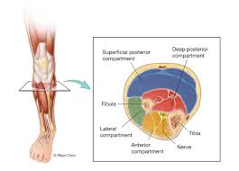 Image result for Compartment Syndrome