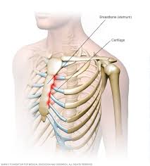 Broken or bruised rib, usually caused by some kind of blunt trauma. Costochondritis Symptoms And Causes Mayo Clinic