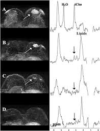 Mrs And Mrsi Guidance In Molecular Medicine Targeting And Monitoring Of Choline And Glucose Metabolism In Cancer Glunde 2011 Nmr In Biomedicine Wiley Online Library