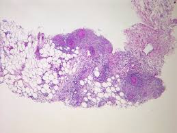 How do you get gastro? Peritonitis Wikipedia