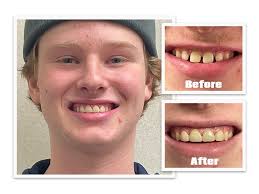 Porcelain Veneers in Burton