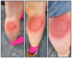 Image result for mosquito bite