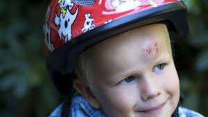 Ako predchádzať letným úrazom detí? Prilba zmenší riziko poranenia hlavy až  o 85 percent