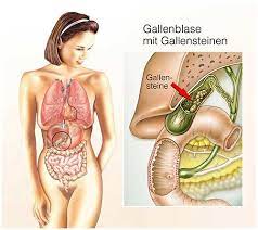 gallenkolik ursachen symptome diagnose behandlung hausmittel krank de