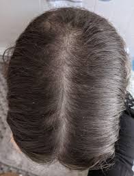 With these products in hand, over 6 weeks, your hair will show more growth, stronger hair strands and deeply moisturized hair stands. 5 Week Progress With Hairgrowthco S 10 In 1 Hair Growth Oil Femalehairloss
