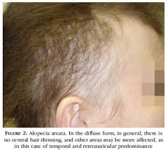 Learn more about possible causes of women's hair loss and what you can do about it most women start to see hair loss in the form of a widening part, diffuse thinning all over or bald patches. Scielo Brasil Clinical And Histological Challenge In The Differential Diagnosis Of Diffuse Alopecia Female Androgenetic Alopecia Telogen Effluvium And Alopecia Areata Part Ii Clinical And Histological Challenge In The
