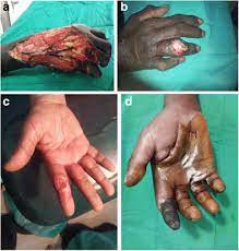Apr 16, 2018 · it can even result in sepsis. Figure 1 Patterns Of Finger Sepsis And Predictors Of Its Outcome In Patients With Diabetic Septic Hand Springerlink