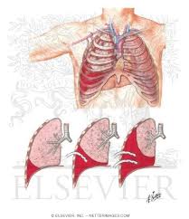 Image result for Hemothorax