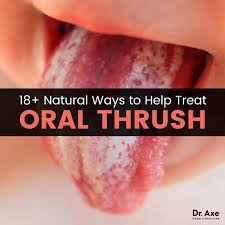 Oral Thrush 18 Natural Treatments To Relieve It Dr Axe Yeast Infection Treatment Oral Thrush Remedies Natural Treatments