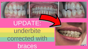 His porcelain veneers are completely different than the traditional porcelain veneer. Live Progress Report Underbite Corrected With Adult Braces And No Surgery With M E A W Technique Youtube