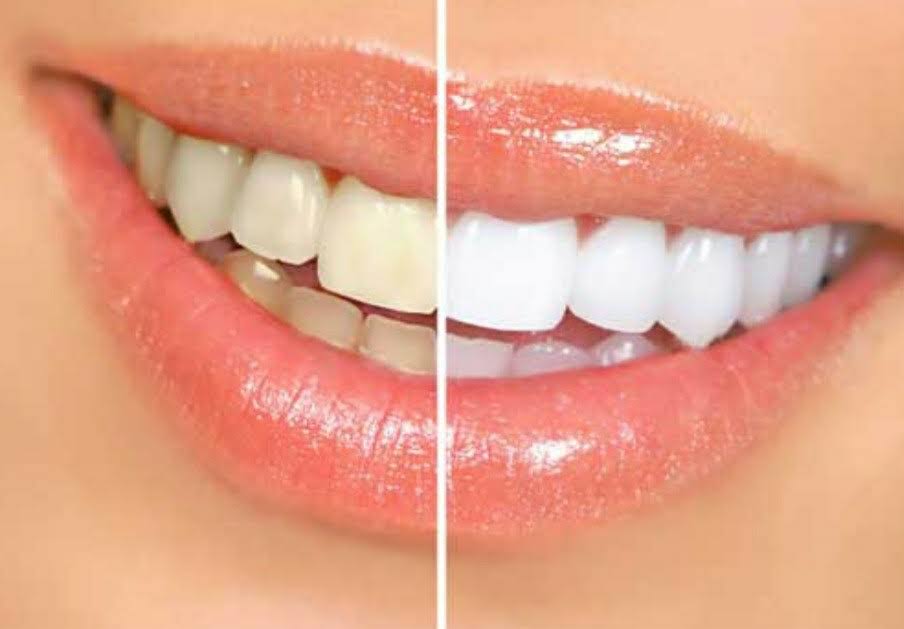 Teeth Whitening Treatment product image