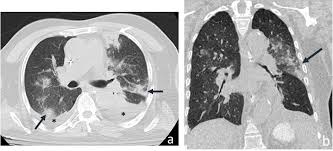 Chest Ct Features Of Covid 19 In The Region Of Abu Dhabi Uae A Single Institute Study Medrxiv