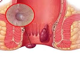 Image result for Perianal Abscess