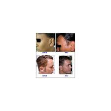 Forehead reduction surgery is a cosmetic procedure that can help to reduce the height of your forehead. Facial Hair Transplant Hair Transplant Cosmetic Surgery Dr M Hair Transplant Clinic Dr Mahadevia Bishan Ahmedabad Id 6630815430