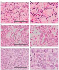 A larger tissue sample is often obtained with an open biopsy. Mesothelioma And Lung Cancer Kudos