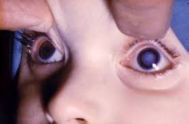 Image result for Rubella