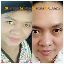 Namun banyak orang yang malu ketika memiliki tahi lalat, terutama yang. Cara Menghilangkan Tahi Lalat Hidup Di Wajah Tanpa Bekas Dalam 1 Hari