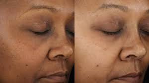 All contents provided are for informational and. Hyperpigmentation Very Dark Skin Pulse Light Clinic London