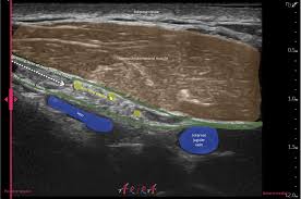 Image result for Superior Trunk Block