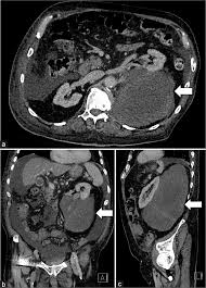 Image result for Liposarcoma