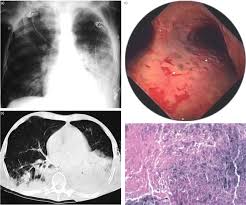 Last update october 5, 2020. Invasive Pulmonary Aspergillosis In Patients With Chronic Obstructive Pulmonary Disease European Respiratory Society