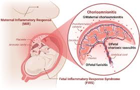 Image result for Chorioamnionitis