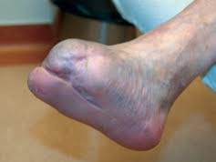 95% aller patienten sind für hausarbeit. 4 3 Diabetisches Fussulcus Ligamed Medical Produkte Gmbh