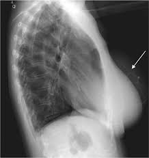 B Lateral Chest Radiograph Shows The Course Of The Vp Shunt Arrow Download Scientific Diagram