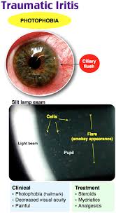 Image result for Ciliary Flush