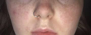 Nose Ring Sizing: How To Pick The Right Ring Size – Dr. Piercing Aftercare