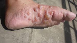 Image result for pompholyx soles of feet