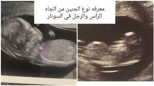 معرفة نوع الجنين من اتجاه الرأس والرجل في صورة السونار Youtube