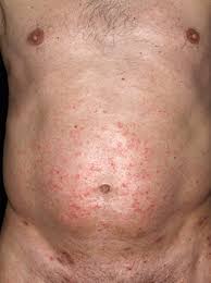 Image result for scabies on humans