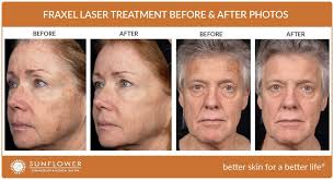 I went to my local dermatologist and had a consultation, scheduled my first appointment,. Fraxel Laser Kansas City What To Expect Kansas City Dermatologists At Epiphany Dermatology
