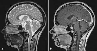We can break down this disease state to better understand it: Entzundliche Wirbelsaulenerkrankungen Springerlink