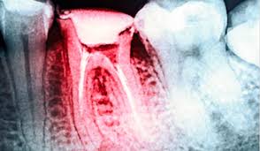 Your first appointment works on fixing the pain you probably. The Myths Truths About Root Canals