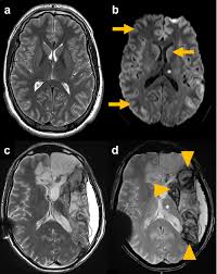 Image result for Brain Lesion