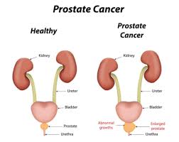 Image result for Prostate Cancer