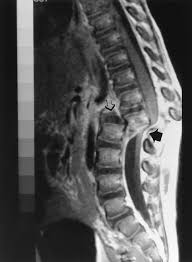 Posted 4 years ago, 3 users are following. Fig 2 Fracture Dislocation Of The Lumbar Spine In An Abused Child American Academy Of Pediatrics