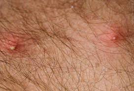 Allergic Reaction Black Ant Bites Pictures Bug Bites Pictures Slideshow Identifying Bugs And Bug Bites Fire Ant Bites Ant Bites Fire Ant Bites Relief